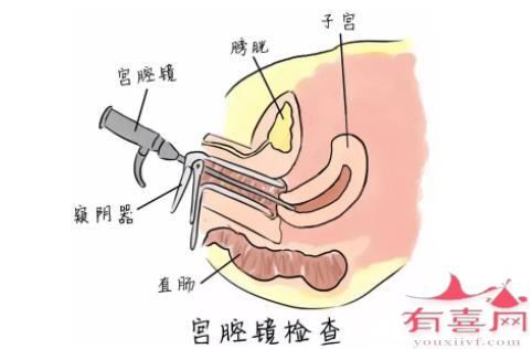 连云港54岁合法供卵：宫颈粘连的自我检测方法有哪些？(图1)